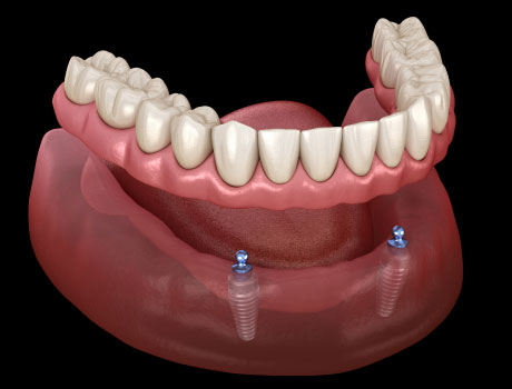 2 Implants